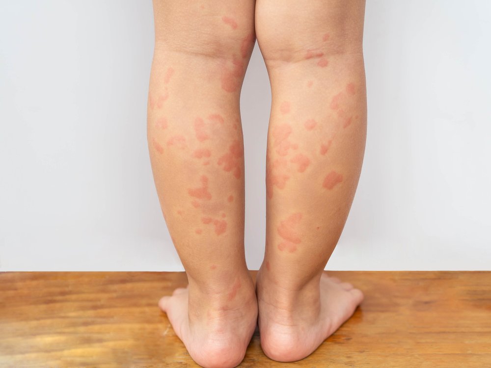 Cover Image of Gejala Alergi Dingin pada Anak dan Cara Mengatasinya