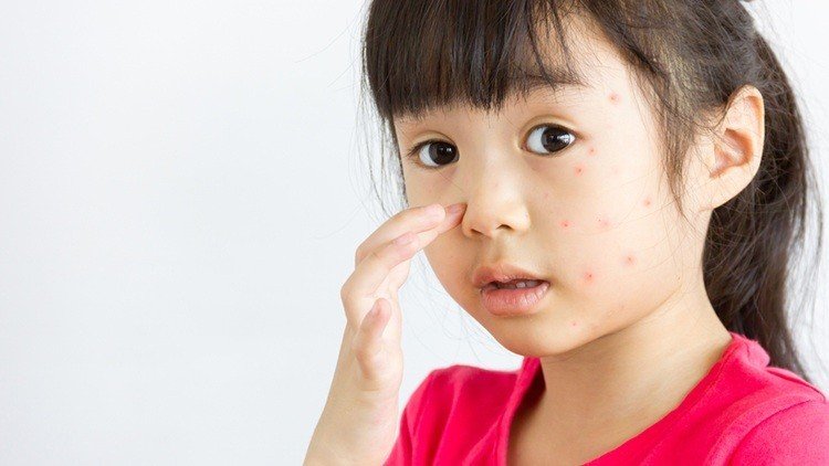 Cover Image of Alergi Dampak Psikologis