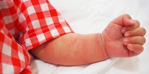 Cover Image of Si Kecil Alergi atau Sakit Kulit