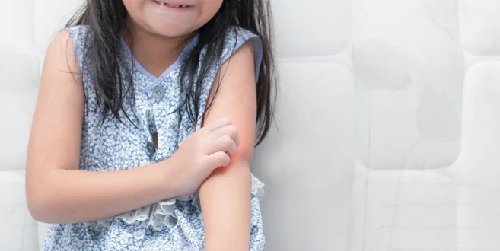 Cover Image of Bunda, Ini 5 Cara Mengatasi Alergi Susu Sapi pada si Kecil