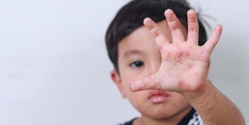 Cover Image of Ketahui Gejala, Penyebab, dan Pengobatan Flu Singapura Pada Anak