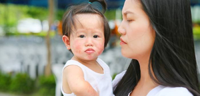 Cover Image of Alergi Kulit pada Anak: Gejala, Jenis, Cara Mengobati